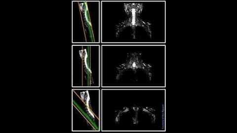 Brachialis Plexus – “angulation” @ Siemens 3T Skyra