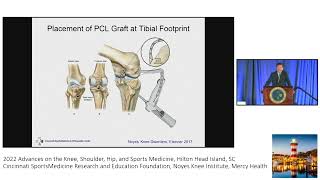 Diagnosis and Treatment of PCL & Posterolateral Ligament injuries : Dr Frank Noyes screenshot 5