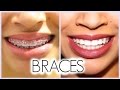 MY 3 YEAR BRACES EXPERIENCE!! (Before/After + Q & A)