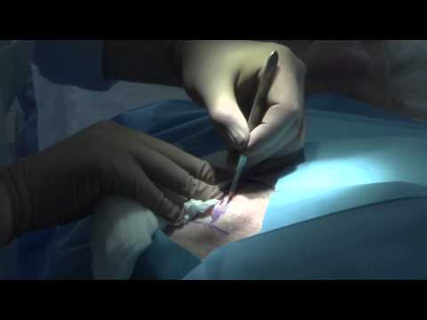 Video: Basalioom Van De Huid - Symptomen, Behandeling, Verwijdering