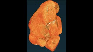 Human Organ Atlas Hip-Ct Imaging Of A Covid-19 Injured Human Spleen Using The Esrf-Ebs