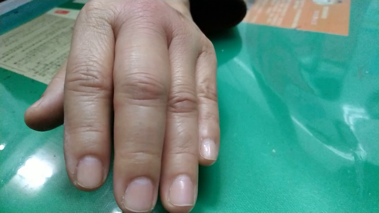 超微創骨科 扳機指治療之新技術