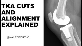 Cuts in TKA Explained Clearly ! And Alignment