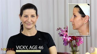 Y LIFT® Chula Vista, CA |  Nowak Aesthetics