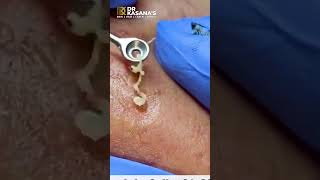 BLACKHEADS REMOVAL By Dr. Lalit Kasanas