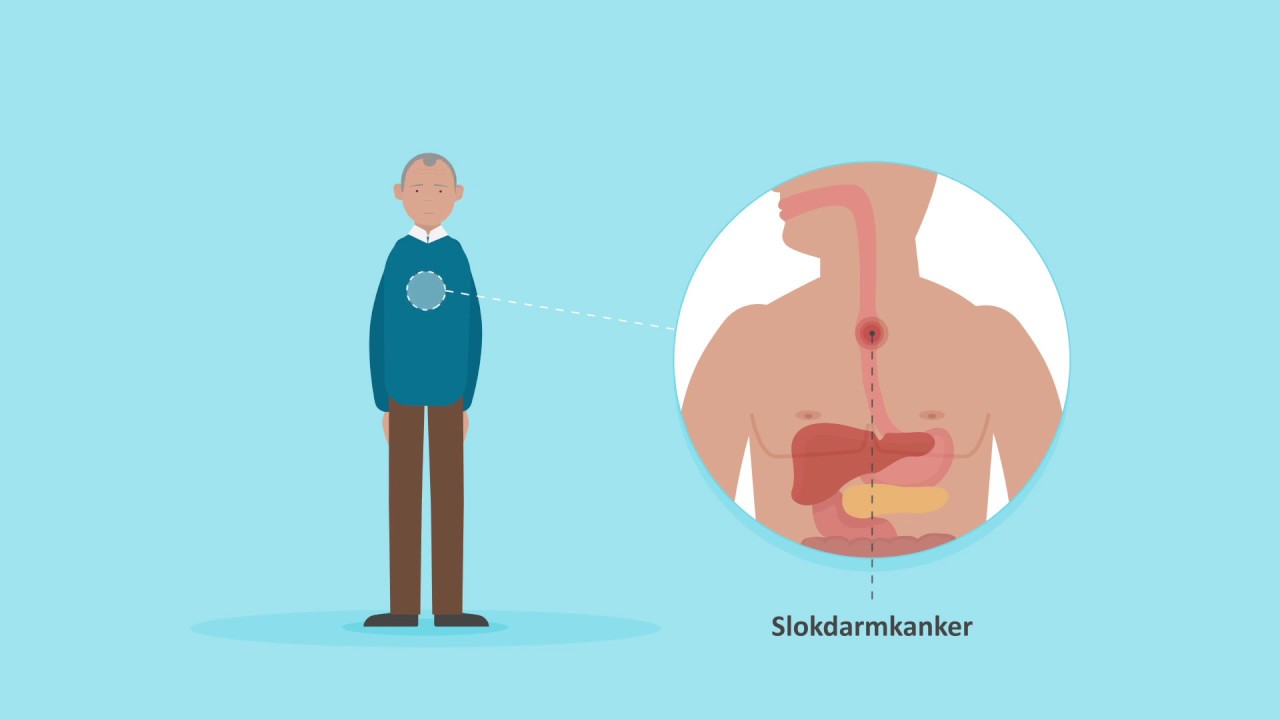 Slokdarmkanker YouTube Slokdarmkanker YouTube