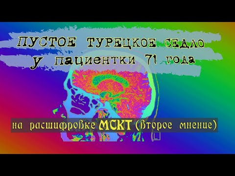 ПУСТОЕ ТУРЕЦКОЕ СЕДЛО и дисциркуляторная ЭНЦЕФАЛОПАТИЯ головного мозга на РАСШИФРОВКЕ КТ мозга