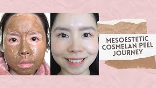 Cosmelan Treatment by Mesoestetic | Removal of Freckles, Melasma & Pigmentation