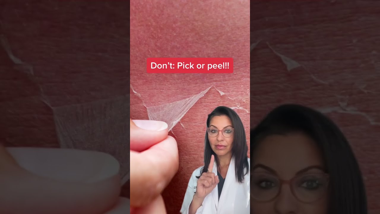 How To Care For A Sunburn According Dermatologist Shorts