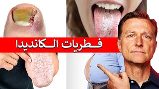 كيفية التخلص من الفطريات دون رجعة (المبيضات أو الكانديدا)