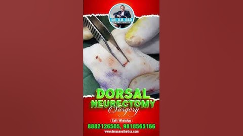 End PME Struggles: Dorsal Neurectomy Surgery for PME Relief.