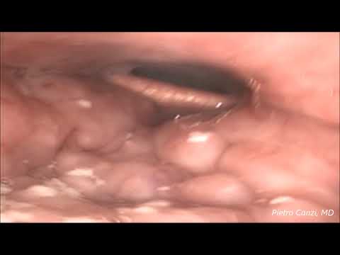 Video: L'endoscopia Del Sonno Indotta Da Farmaci Può Migliorare Le Percentuali Di Successo Della Chirurgia Della Lingua Base?