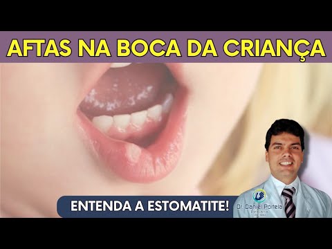 Vídeo: 11 maneiras de tratar uma afta ou bolhas de febre