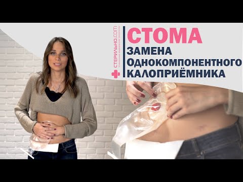 Как заменить однокомпонентный калоприемник для стомы?  | Стерильно.com