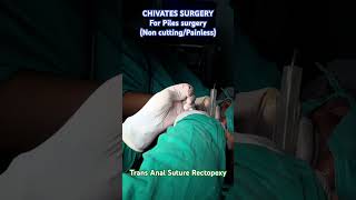 Chivates Procedure Transanal Suture Rectopexy By Dr Saurabh Patel
