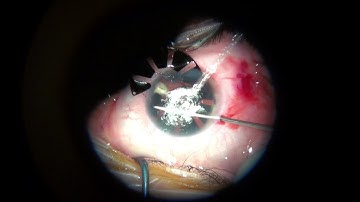Aniridia partial iris implantation with cataract removal in the eye with congenital aniridia, catara