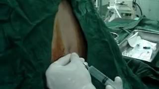 Epidural Anesthesia