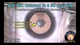 CataractCoach 1215: soft posterior subcapsular cataract in a 30 year old