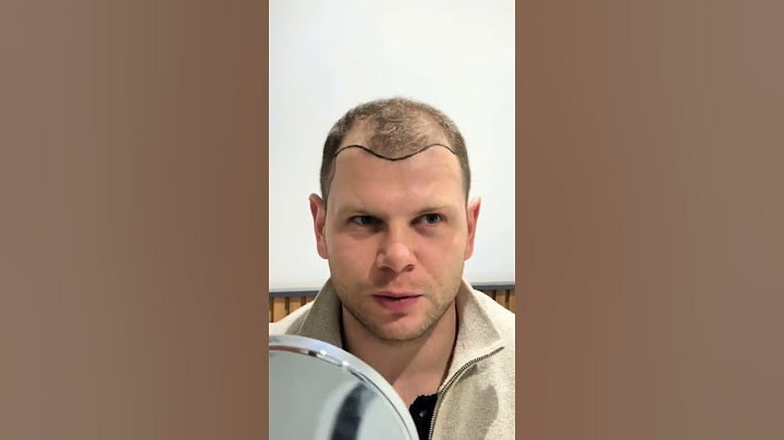 Hair Transplant Before and After Operation | Hair Transplant in Turkey #hairtransplant