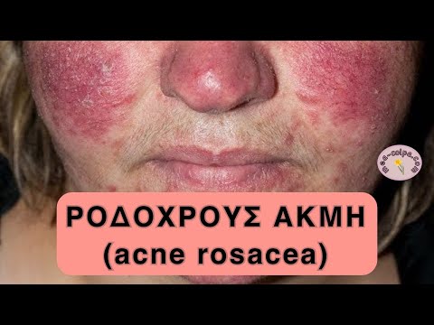 Ροδόχρους ακμή - Rosacea