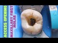 Access opening  maxillary first molar  step by step demonstration