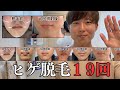【ヒゲ脱毛】何回必要？おすすめは？19回医療脱毛した男の体験談 #医療脱毛 #ヒゲ脱毛