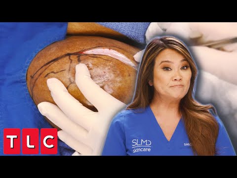 "I Need a Bra For This" Dr. Lee Removes Gigantic Lipoma from Patient