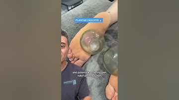 Cupping Therapy for Feet | The Ultimate Plantar Relief Technique?