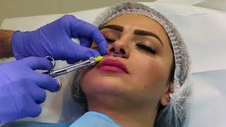 Double Chin liposuction | Up lip lifting | Threads | Actress Lulwa at DewDerm