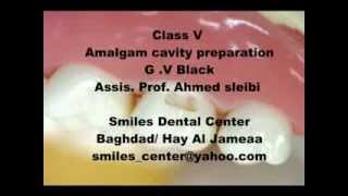 Amalgam Class V cavity preparation - Dr. Ahmed Sleibi Smiles center