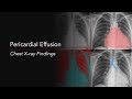 Pericardial effusion explanation of chest xray findings water bottle heart