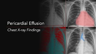 Pericardial Effusion: Explanation of Chest X-ray Findings (Water Bottle Heart)