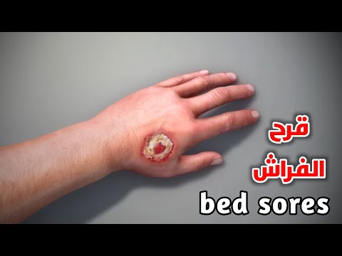 يعني اية قرح فراش وازاي بنغير عليها