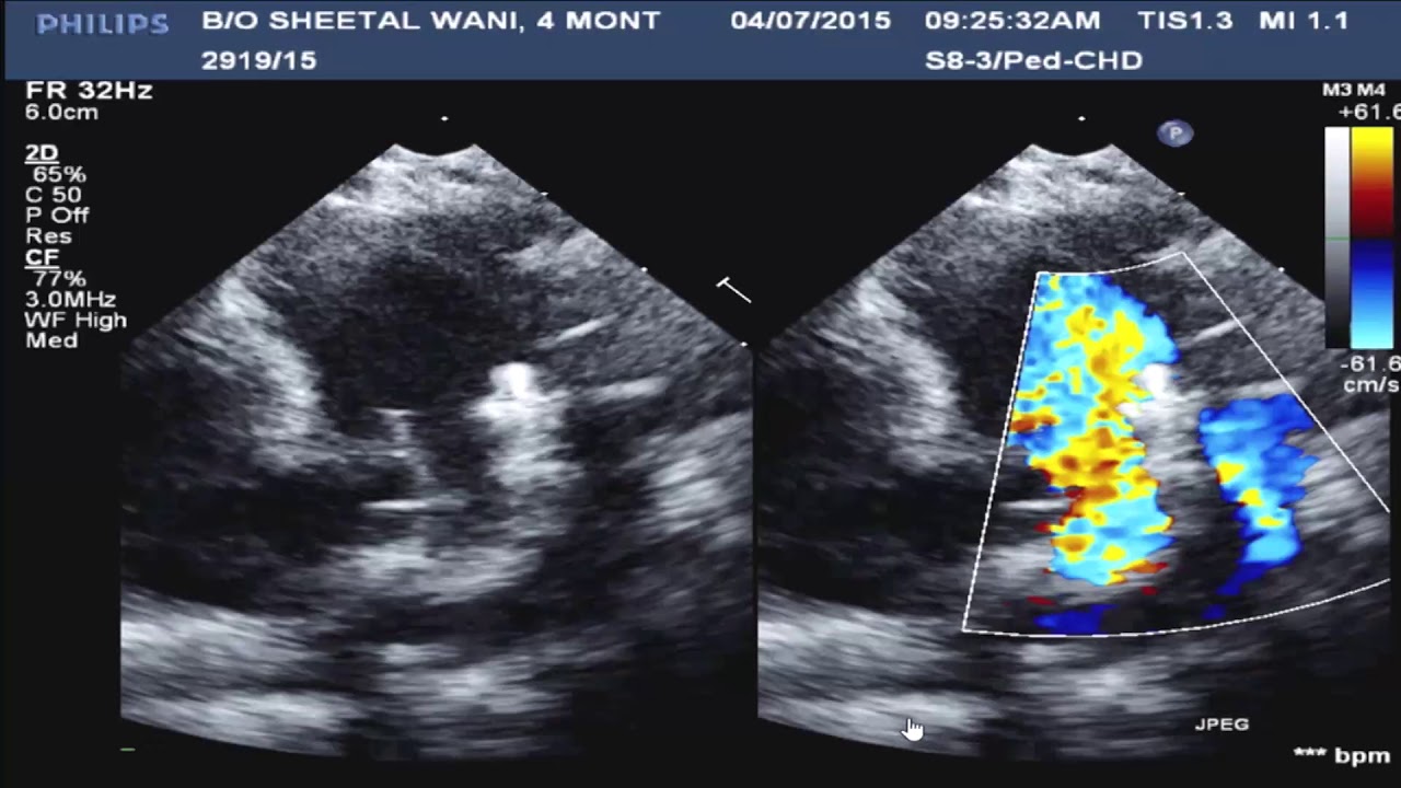 Why AVP II for long ducts in infancy?