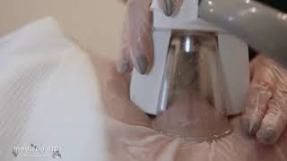 Medispa S10 Sheffield - 3D Lipo