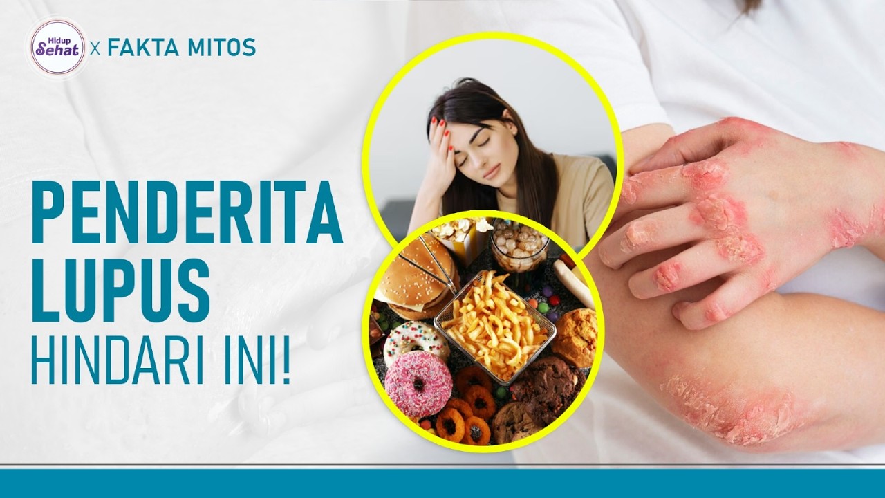 Tips Mengontrol Lupus, Hindari Sederet Kebiasaan Ini | Hidup Sehat ...