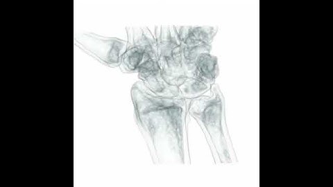 Patient 4  right clenched fist motion