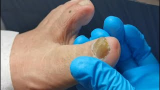 How to treat yellow and hard fungus nails. Fungal nail treatment &amp; ingrown toenails removal.