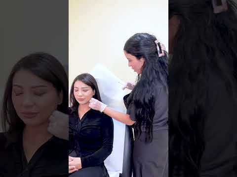 Botox Masseter treatment