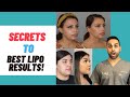 Double Chin Removal: Lipo Secrets