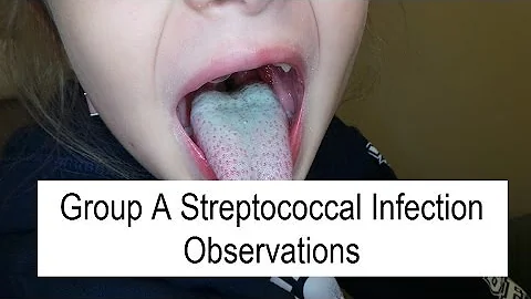 Come si contrae streptococco Agalactiae?