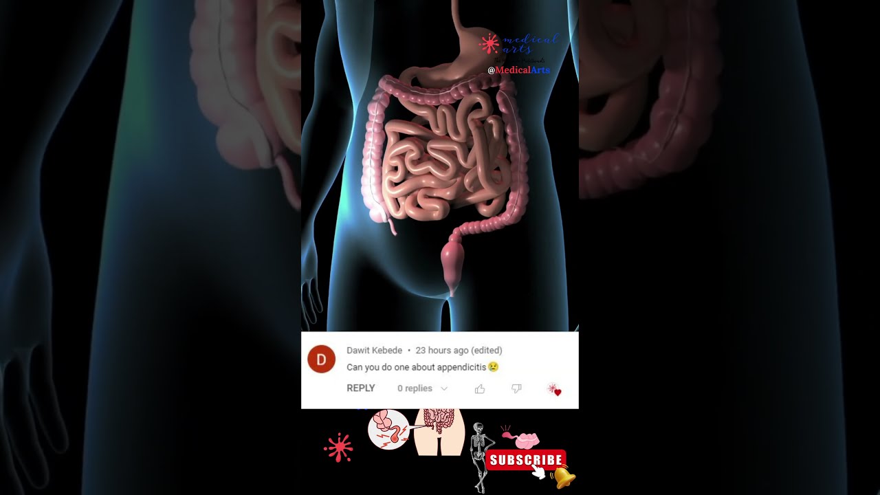 Appendicitis Appendix Location Symptoms