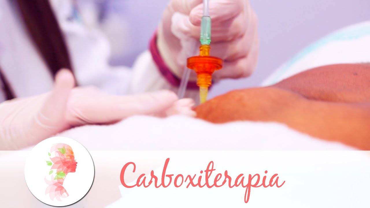 Carboxiterapia trata estrias, celulite e gordura localizada