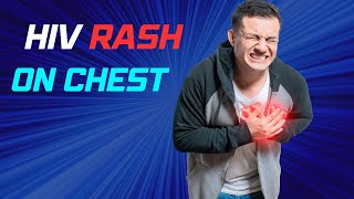 What does HIV rash look like: HIV rash on the chest