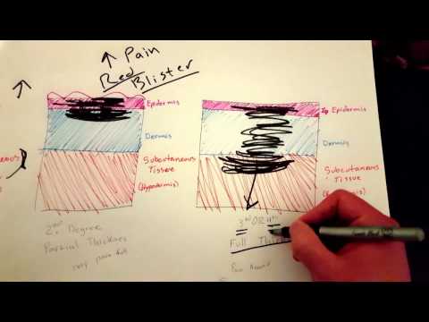 EMT Burns (1st, 2nd, & 3rd Degree) / EMT MADE EASY