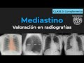 04 y 05 - Alteraciones mediastinales en radiografía de tórax (Complemento)