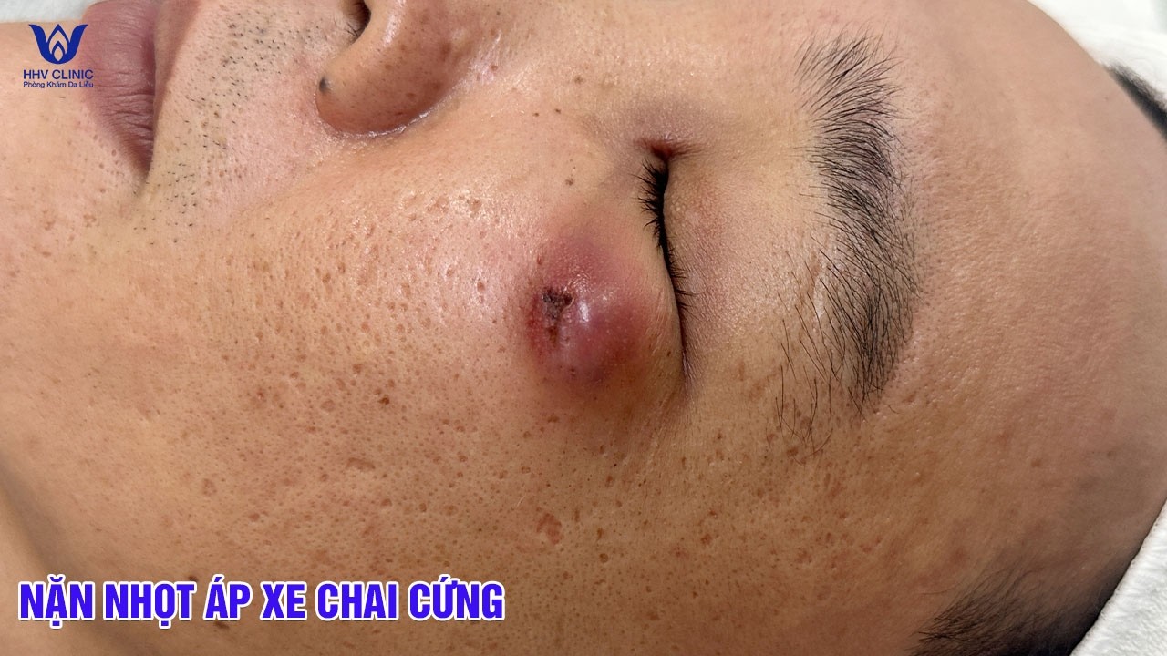 Nặn mụn nhọt sưng viêm to ở mắt - Tại phòng khám da liễu HHV Clinic.