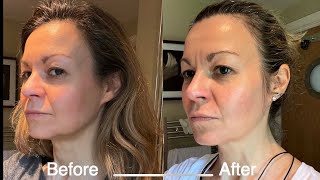 NuFace microcurrent review: My before and after results 4 months in