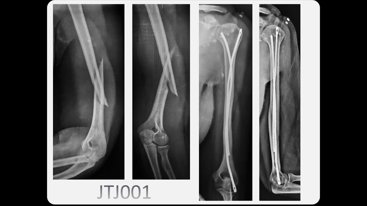 Pediatric humeral fracture fixed by a single retrograde titanium elastic  nail | Semantic Scholar
