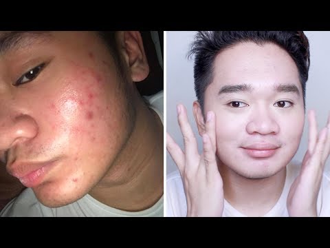 DRY UP YOUR PIMPLES in  Days with Benzoyl Peroxide! / Sir Paul Maynard